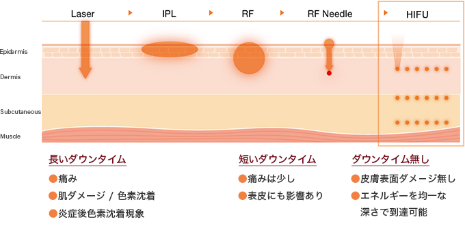 HIFU